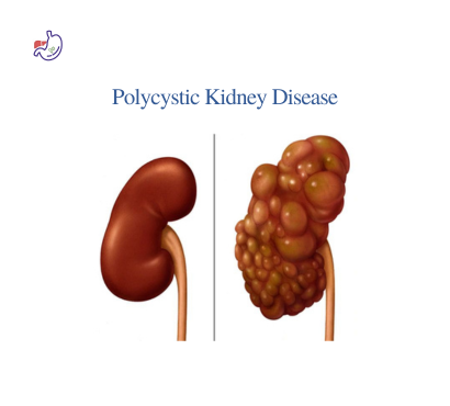 polycystic-kidney-disease