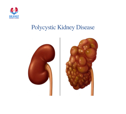 Polycystic Kidney Disease (PKD) – Causes, Symptoms, and Treatment